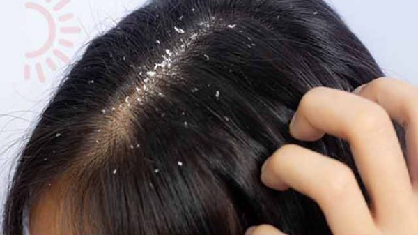 চুলের শুষ্কতা