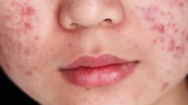 ব্রণ দূর