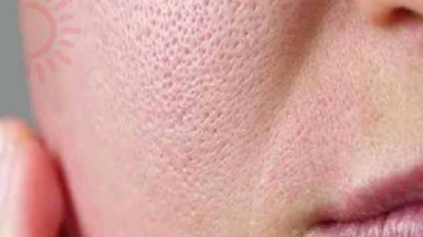 ত্বকের গর্ত