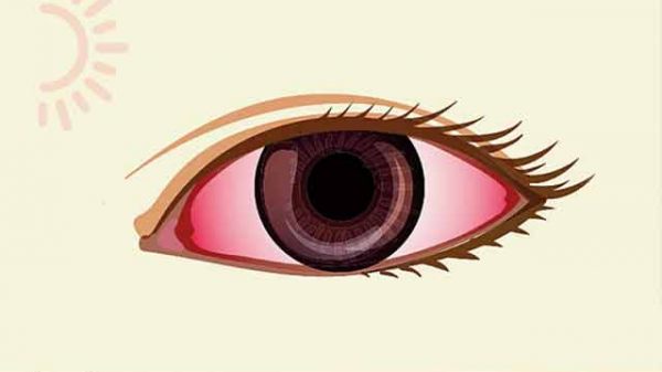গরমে চোখের সমস্যা