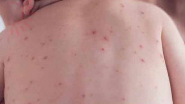 হামের প্রকোপ