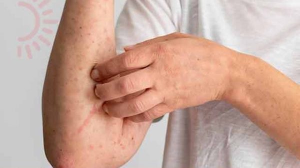 অ্যালার্জি সমস্যা