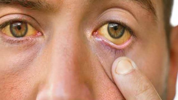 জন্ডিসের চিকিৎসা