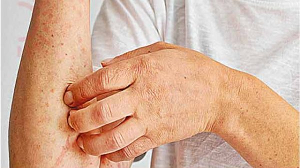 খোসপাঁচড়া আতঙ্কে