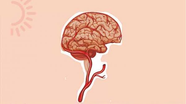 নারীদের স্ট্রোক